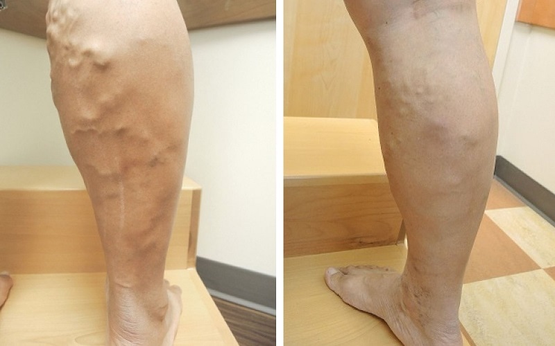 before and after vein ablation