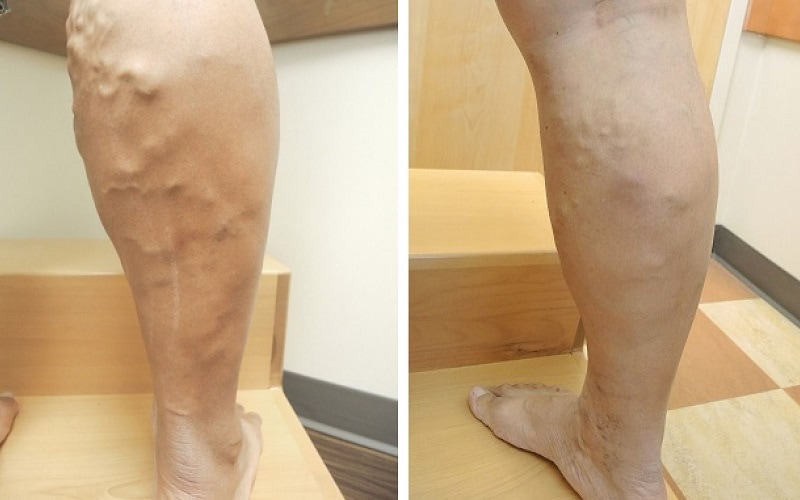 before-after-vein-ablation before and after vein ablation