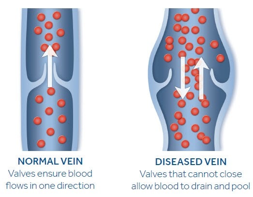 normal and diseased vein